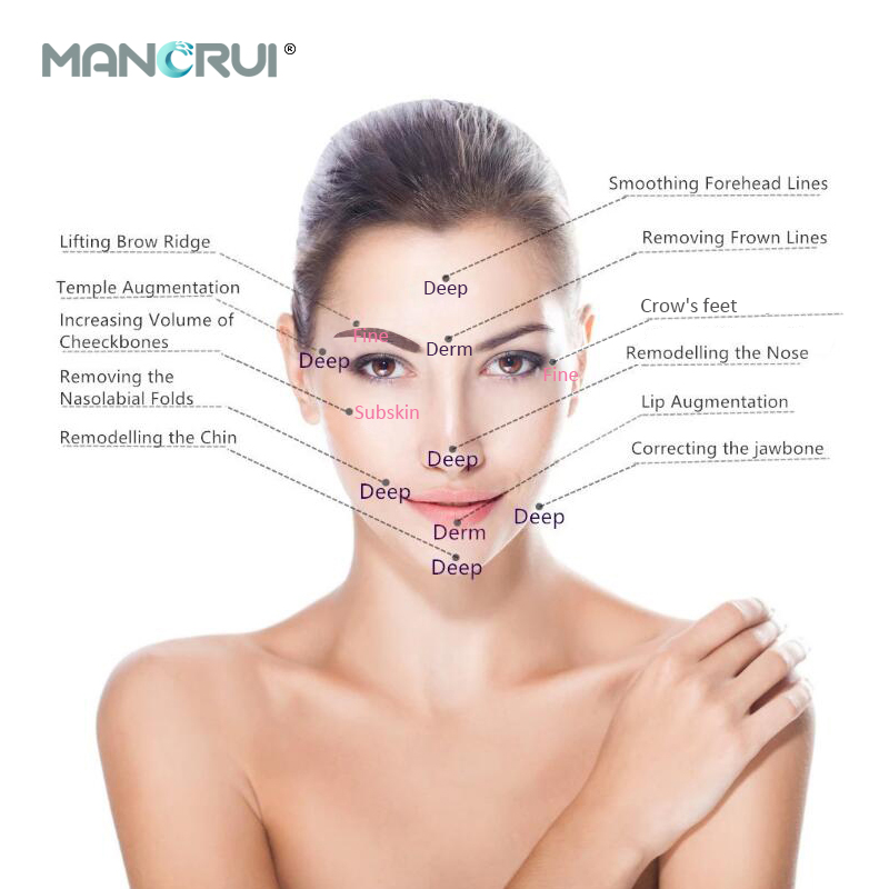 Hyaluronic Acid Injection - MANORUI
