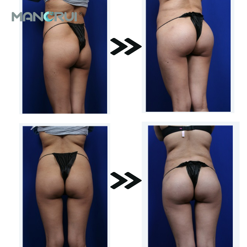 Hyaluronic Acid Injection - MANORUI